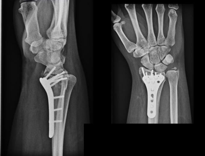 Jak Leczy Z amanie Nadgarstka Rehabilitacja Gda sk R cito